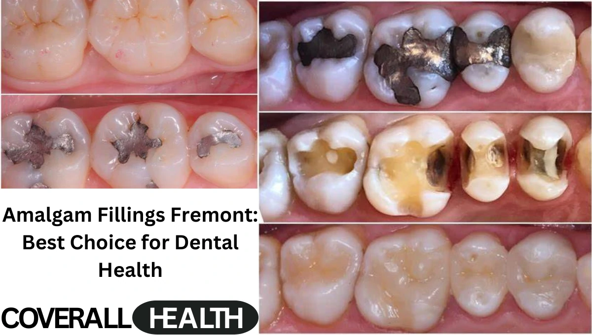 Amalgam Fillings Fremont